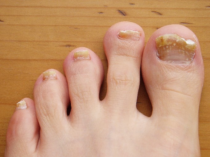 best toenail fungus treatment