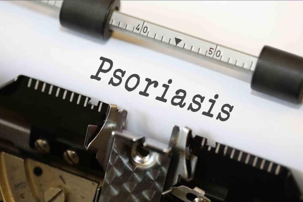 Using oregano oil for Psoriasis